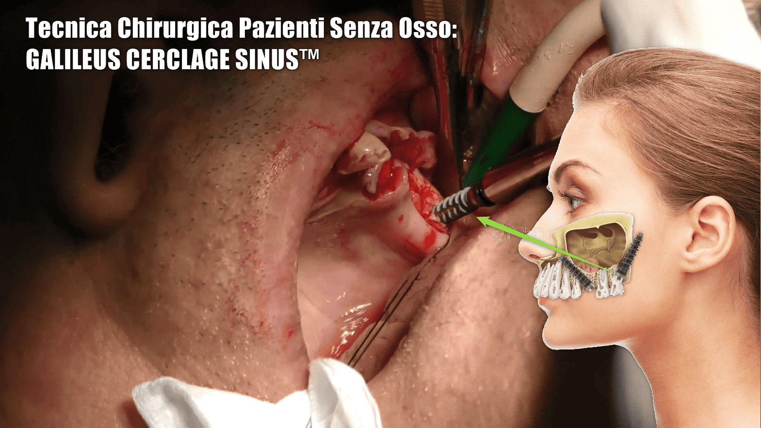 immagine che mostra tecnica chirurgica de galileus cerclage sinus