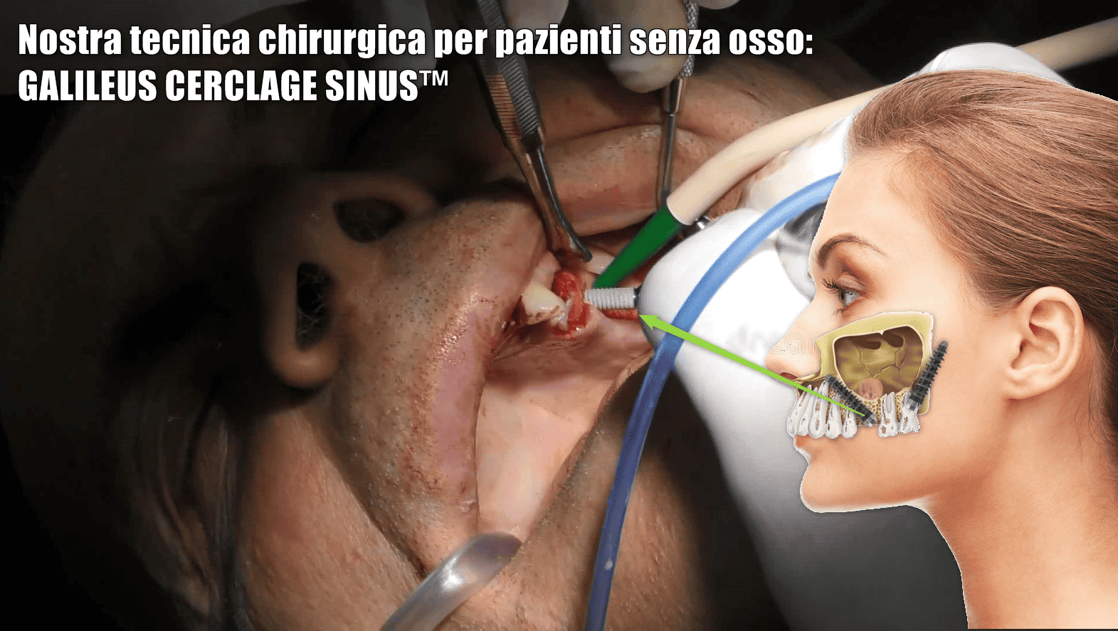 immagine che mostra tecnica chirurgica de galileus cerclage sinus